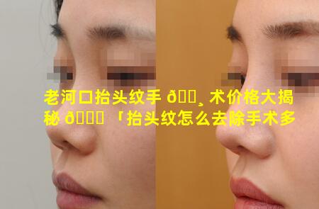 老河口抬头纹手 🕸 术价格大揭秘 🐘 「抬头纹怎么去除手术多少钱」